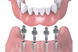 implantologie - proteze implant dentar